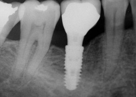Powłoka na implanty dentystyczne – bakterie bez szans!