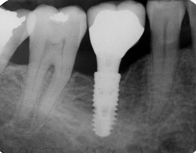 powłoka na implanty stomatologiczne